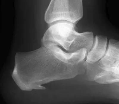 Radiograph from the case bank: Calcaneal spur