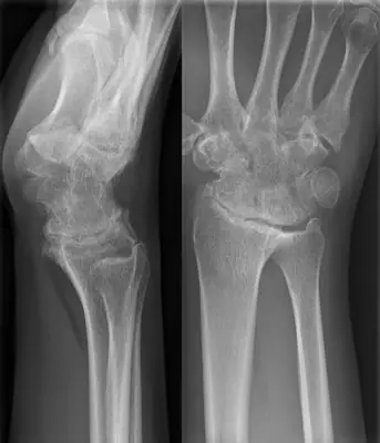 Radiograph from the case bank: Rheumatoid arthritis