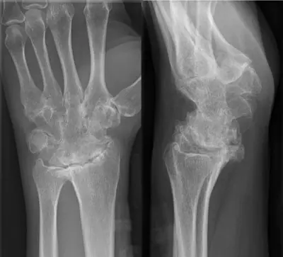Radiograph from the case bank: Rheumatoid arthritis