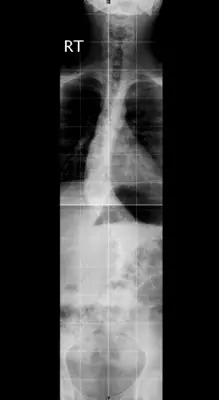 Radiograph from the case bank: Scoliosis