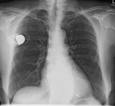 Radiograph from the case bank: Cardiac pacemaker
