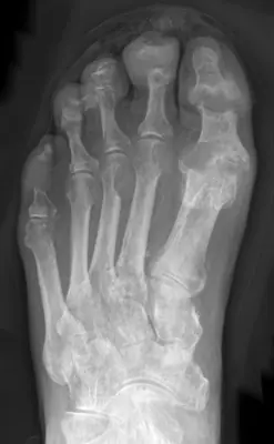 Radiograph from the case bank: Gout