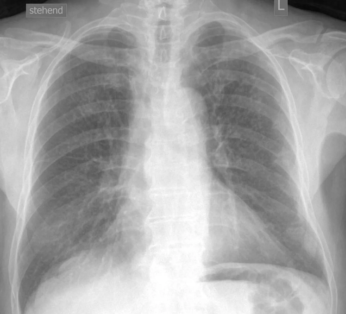 Chest radiograph for self-assessment
