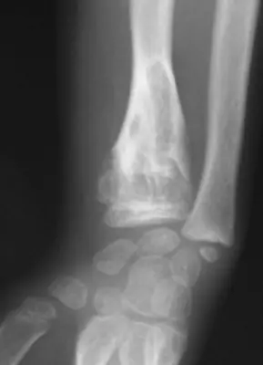 Radiograph from the case bank: Enchondroma