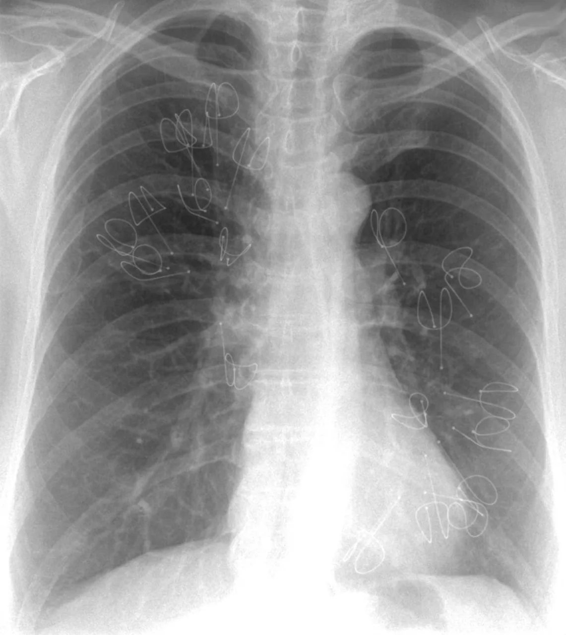 Chest radiograph for self-assessment