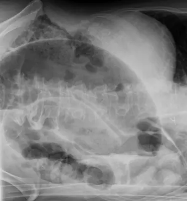 Radiograph from the case bank: Volvulus