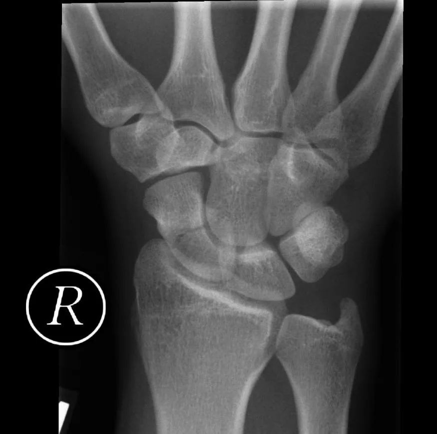 Upper limb radiograph for self-assessment