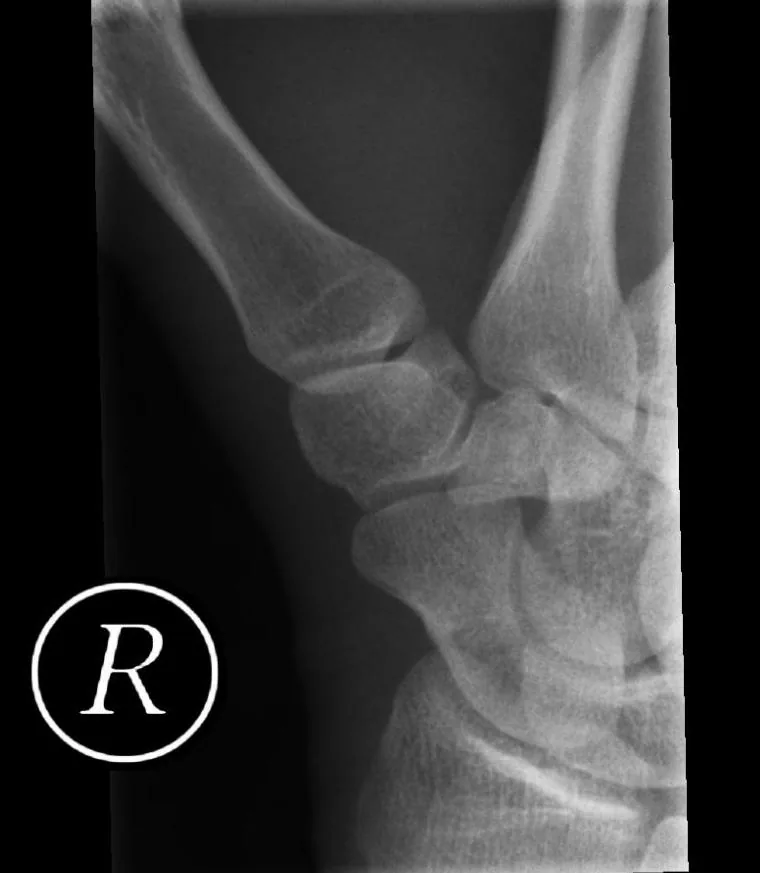Upper limb radiograph for self-assessment