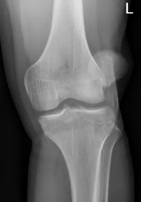Radiograph from the case bank: Patellar dislocation