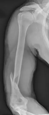 Radiograph from the case bank: Humeral shaft fracture
