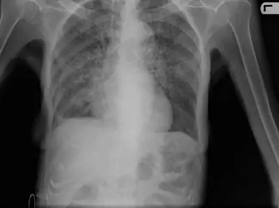 Radiograph from the case bank: Pulmonary tuberculosis