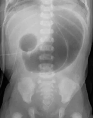 Radiograph from the case bank: Double bubble sign (duodenal atresia)