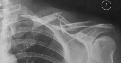 Radiograph from the case bank: Clavicle fracture