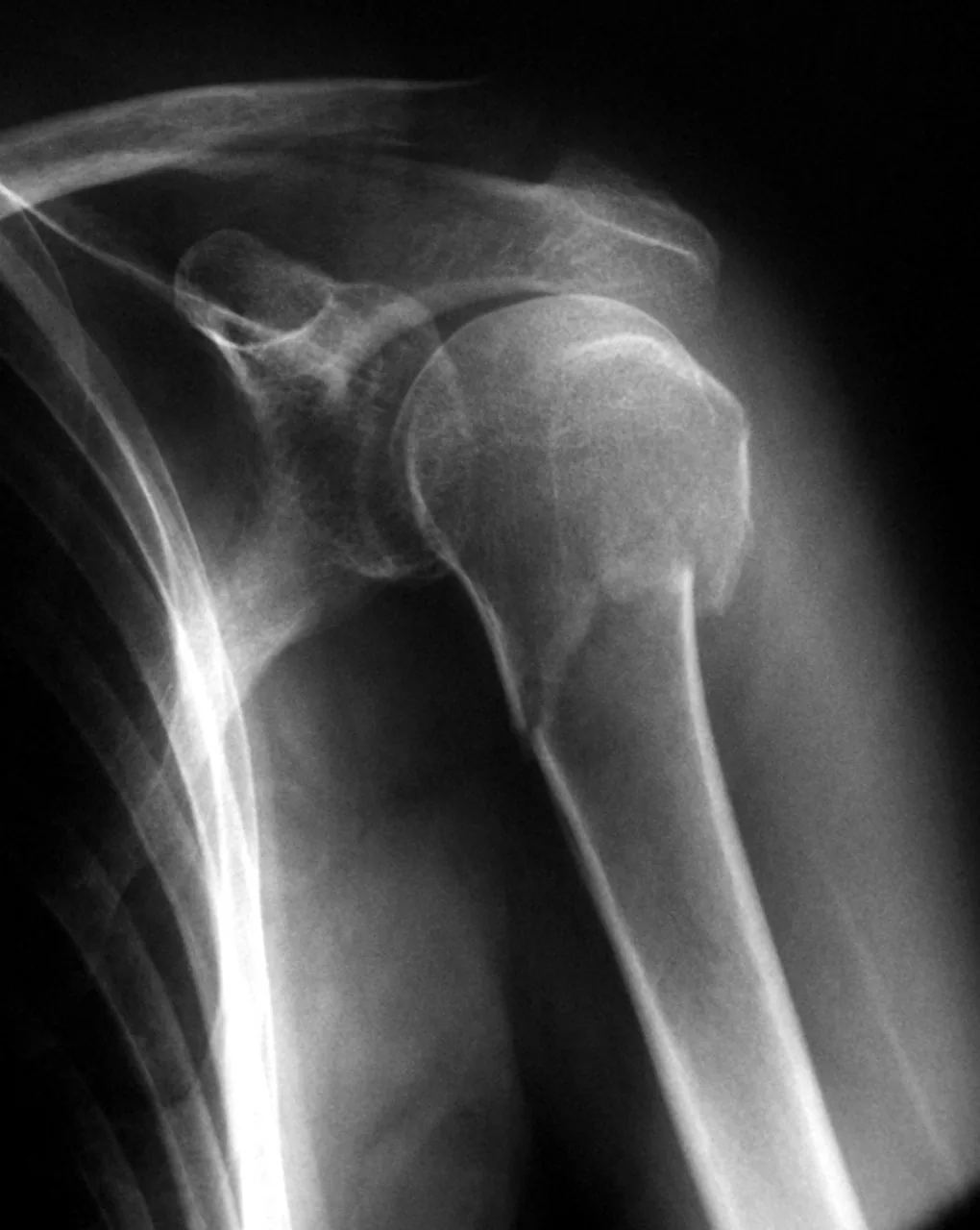 Upper limb radiograph for self-assessment