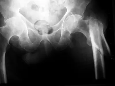 Radiograph from the case bank: Hip (proximal femoral) fracture