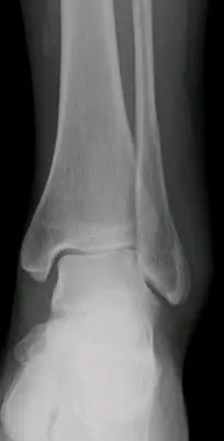 Radiograph from the case bank: Ankle fracture (lateral malleolus)