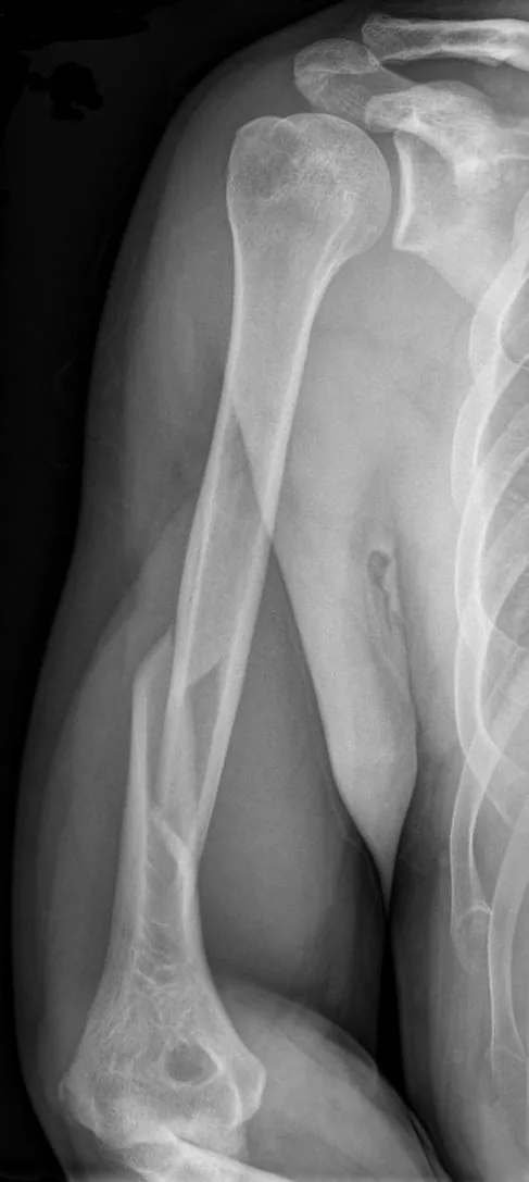 Upper limb radiograph for self-assessment
