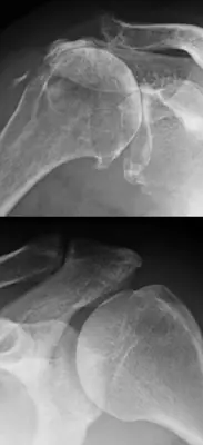 Radiograph from the case bank: Osteoarthritis