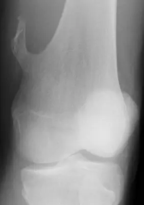 Radiograph from the case bank: Osteochondroma (exostosis)