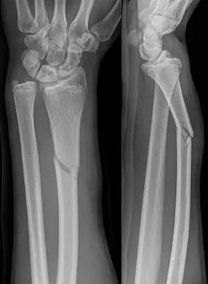 Radiograph from the case bank: Galeazzi fracture-dislocation