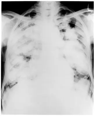 Radiograph from the case bank: Pulmonary tuberculosis