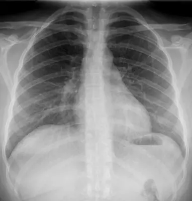 Radiograph from the case bank: Cervical rib
