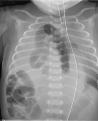Radiograph from the case bank: Diaphragmatic hernia
