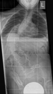 Radiograph from the case bank: Scoliosis