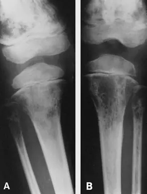 Radiograph from the case bank: Bone metastases