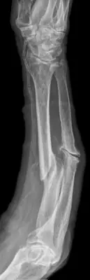 Radiograph from the case bank: Forearm shaft fracture (radius and ulna)