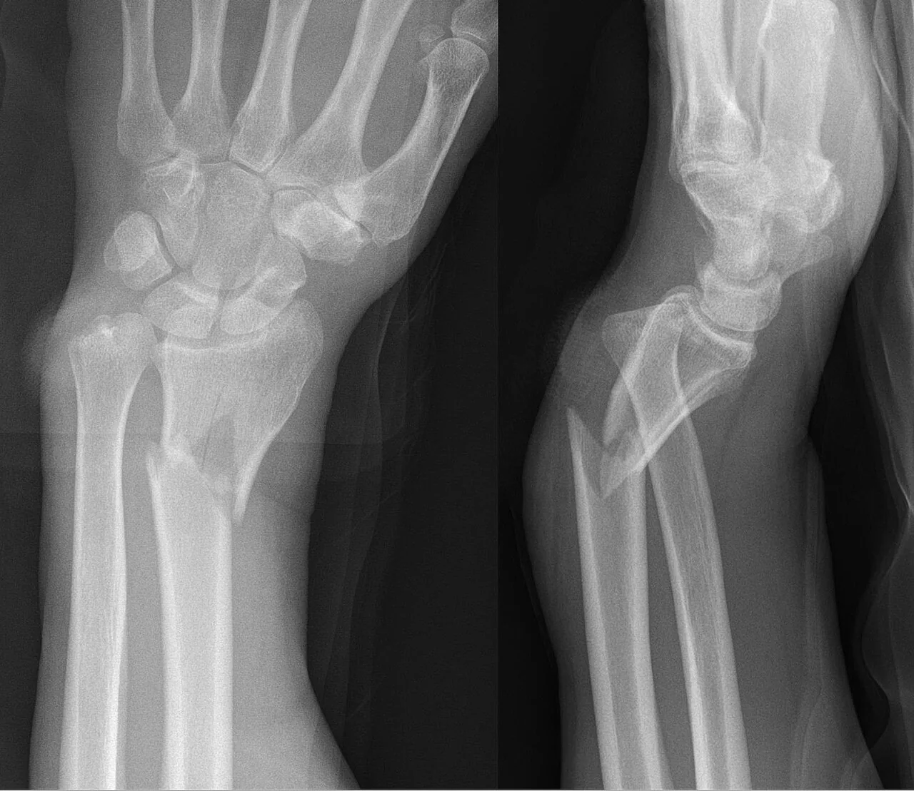 Upper limb radiograph for self-assessment