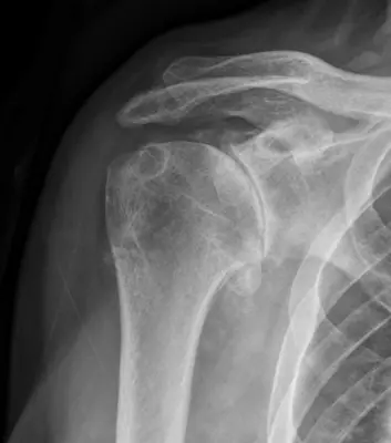 Radiograph from the case bank: Osteoarthritis