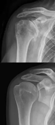 Radiograph from the case bank: Osteoarthritis