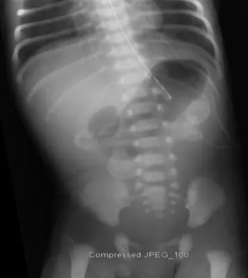 Radiograph from the case bank: Double bubble sign (duodenal atresia)