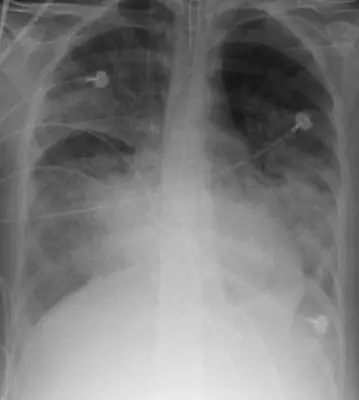 Radiograph from the case bank: Pulmonary oedema (heart failure)