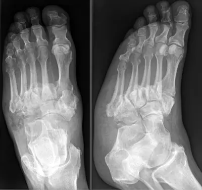 Radiograph from the case bank: Neuropathic (Charcot) arthropathy