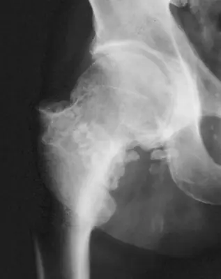 Radiograph from the case bank: Synovial chondromatosis