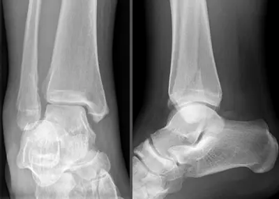 Radiograph from the case bank: Ankle fracture (lateral malleolus)