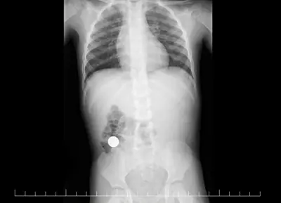 Radiograph from the case bank: Foreign body (ingested or inserted)