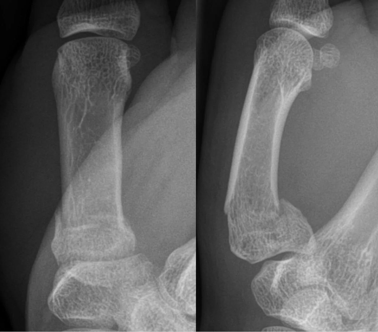 Upper limb radiograph for self-assessment