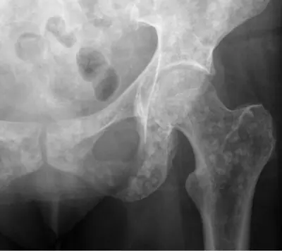 Radiograph from the case bank: Bone metastases