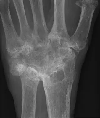 Radiograph from the case bank: Rheumatoid arthritis
