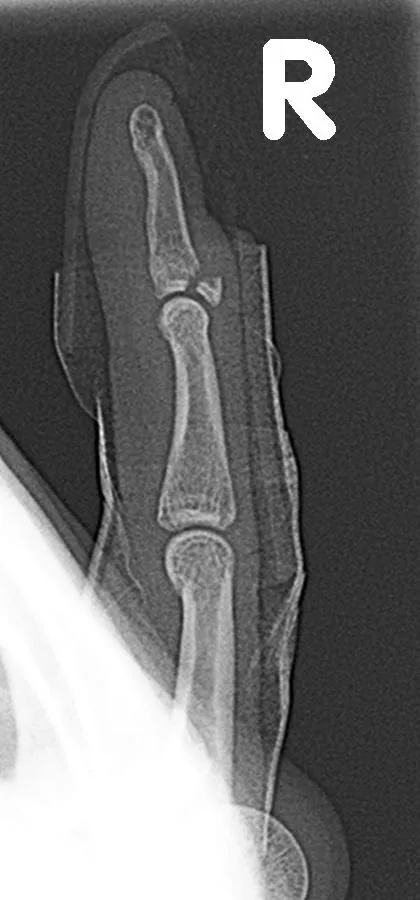 Upper limb radiograph for self-assessment