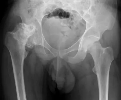 Radiograph from the case bank: Avascular necrosis of the femoral head