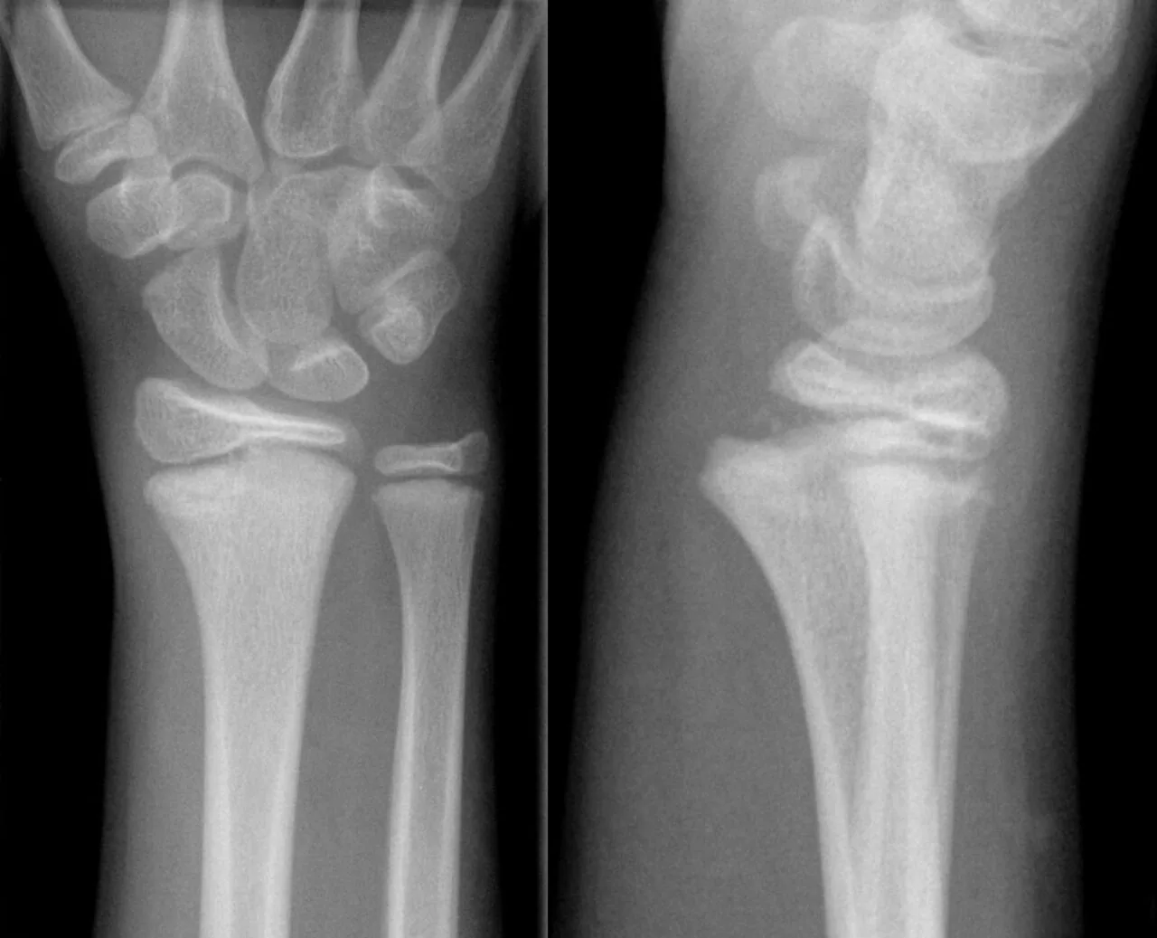 Upper limb radiograph for self-assessment
