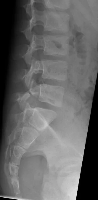 Spine radiograph for self-assessment