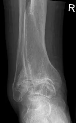 Radiograph from the case bank: Osteoarthritis