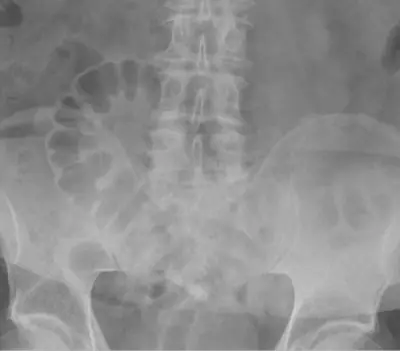 Radiograph from the case bank: Pneumoperitoneum (free intraperitoneal gas)