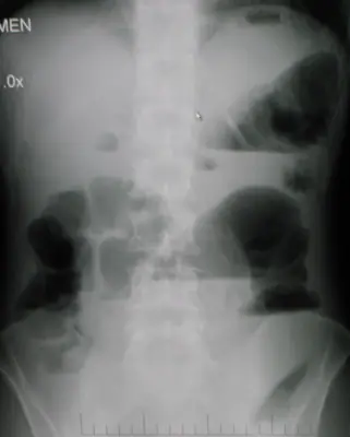 Radiograph from the case bank: Bowel obstruction