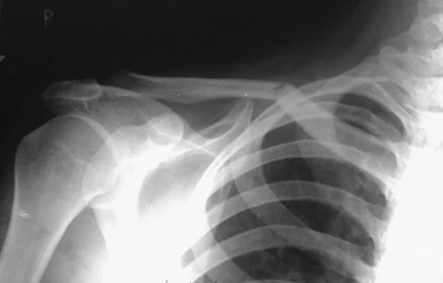 Upper limb radiograph for self-assessment